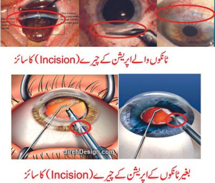 How cataract operation is performed?