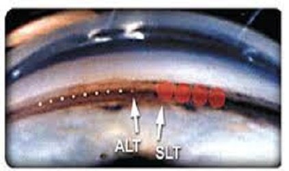 How open angle glaucoma is treated?