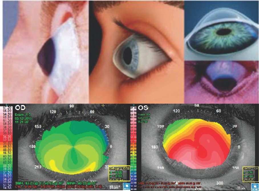 What is corneal cross-linking?