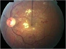 میکولوپیتھی Maculopathy