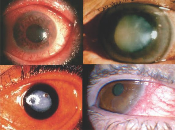 What is a cataract?