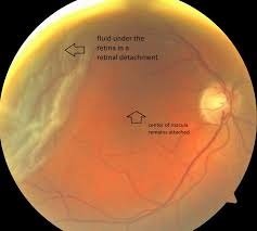 Retinal detachment