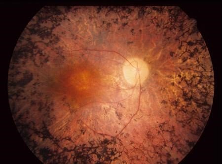 Retinitis pigmentosa