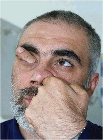 What basically the issue in epiphora patients and how do you treat?