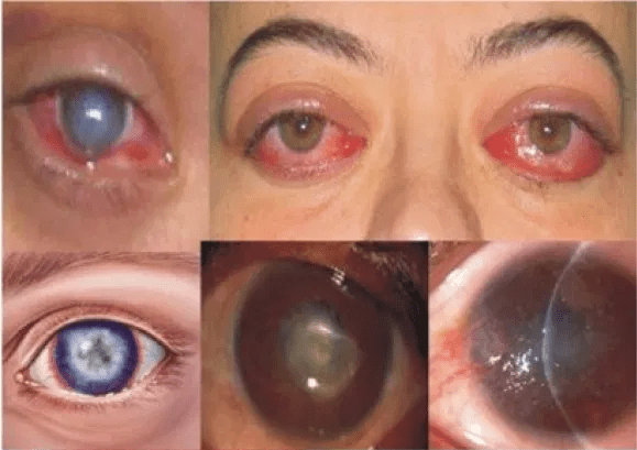 Corneal diseases