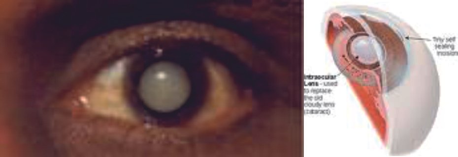 What is a cataract? Why it develops?