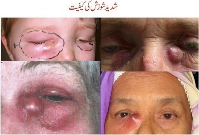 What other symptoms can be associated with watering?